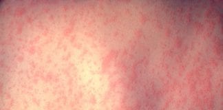 Confirmed case of measles in the West as close contacts notified galway measles