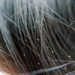 Head lice