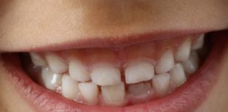 Over 5,000 children in Galway waiting for routine dental appointments galway daily news dental appointemnts children galway